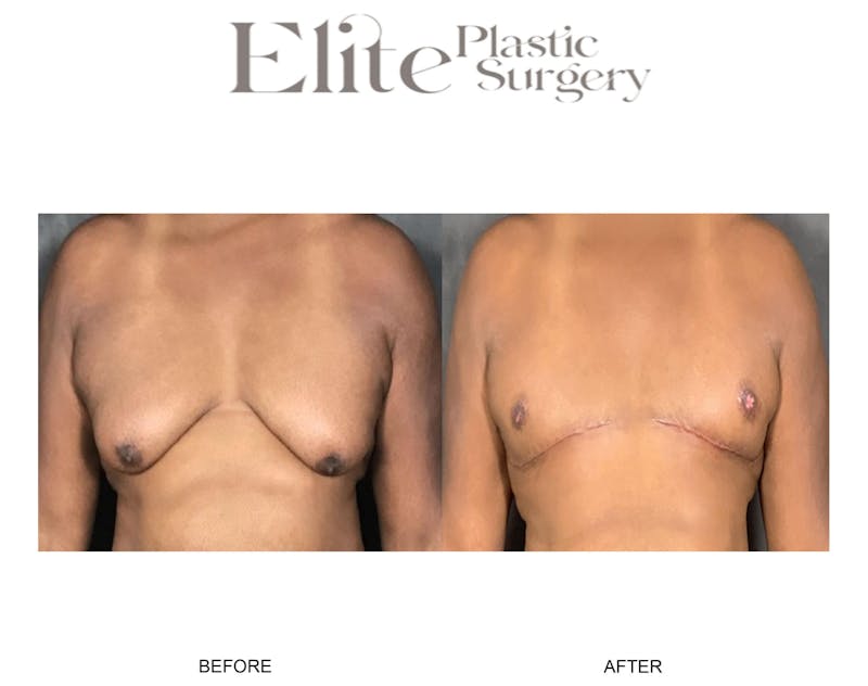 Male Gynecomastia Before & After Gallery - Patient 126420 - Image 1