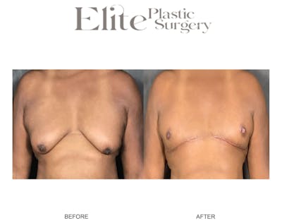 Male Gynecomastia Before & After Gallery - Patient 126420 - Image 1
