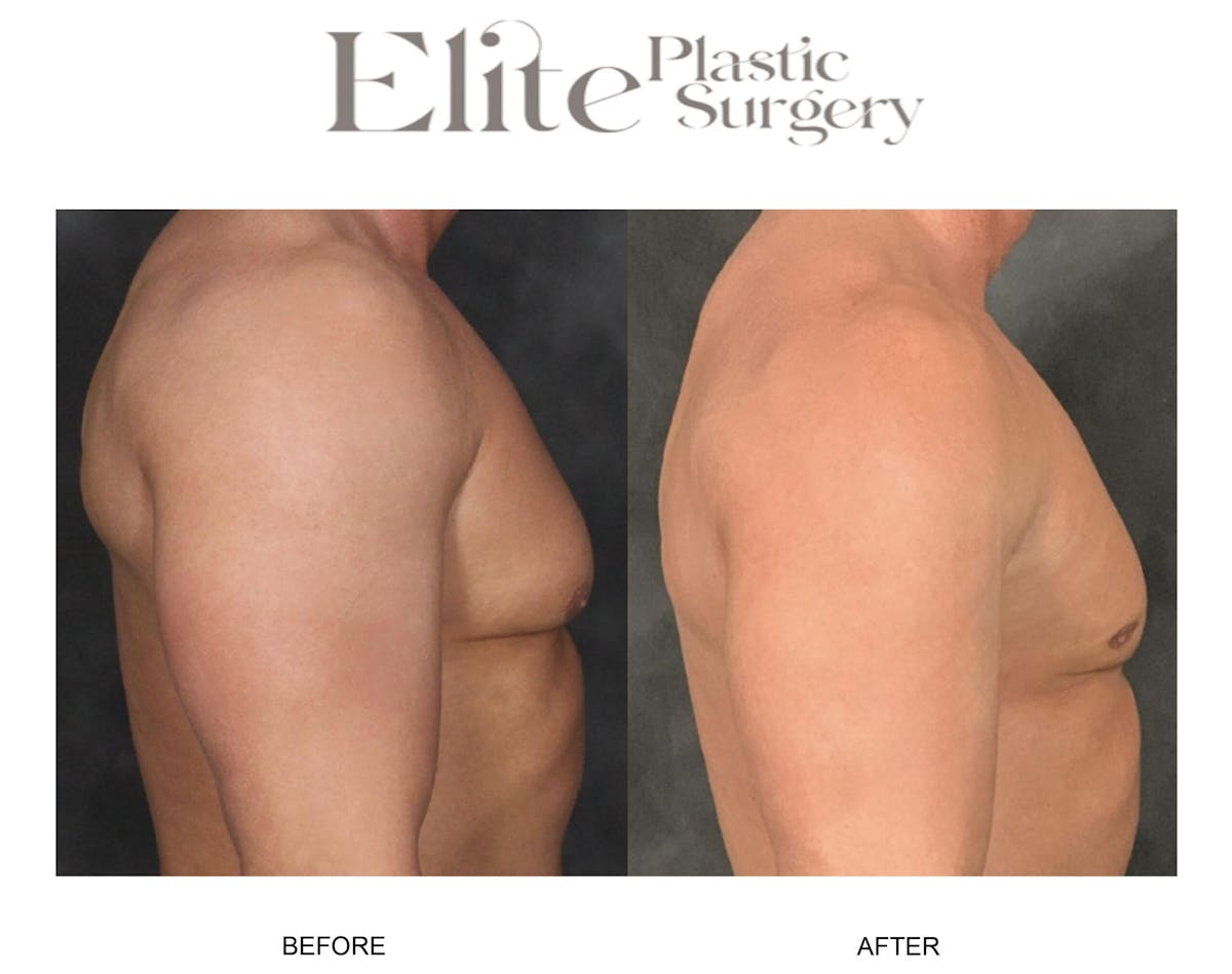 Male Gynecomastia Before & After Gallery - Patient 382441 - Image 2