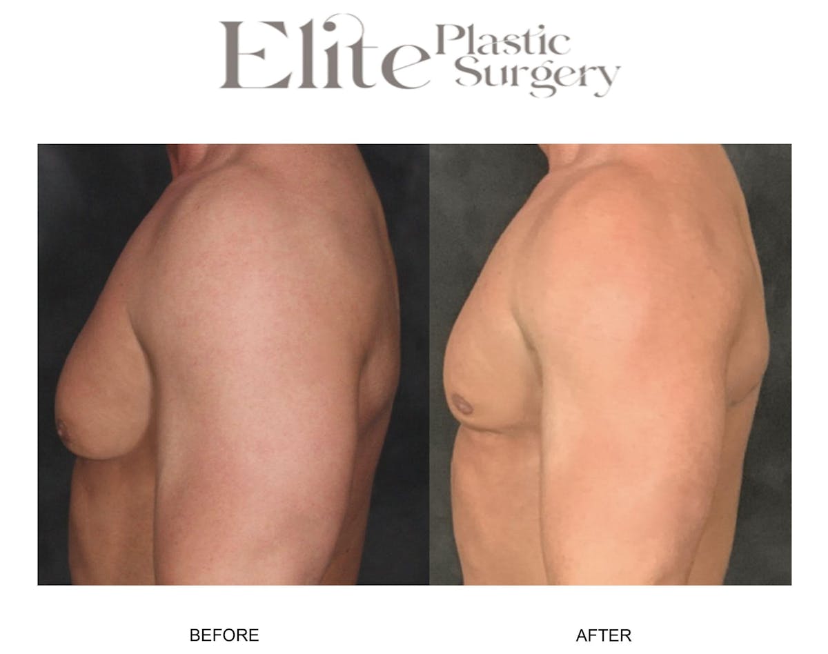 Male Gynecomastia Before & After Gallery - Patient 382441 - Image 3