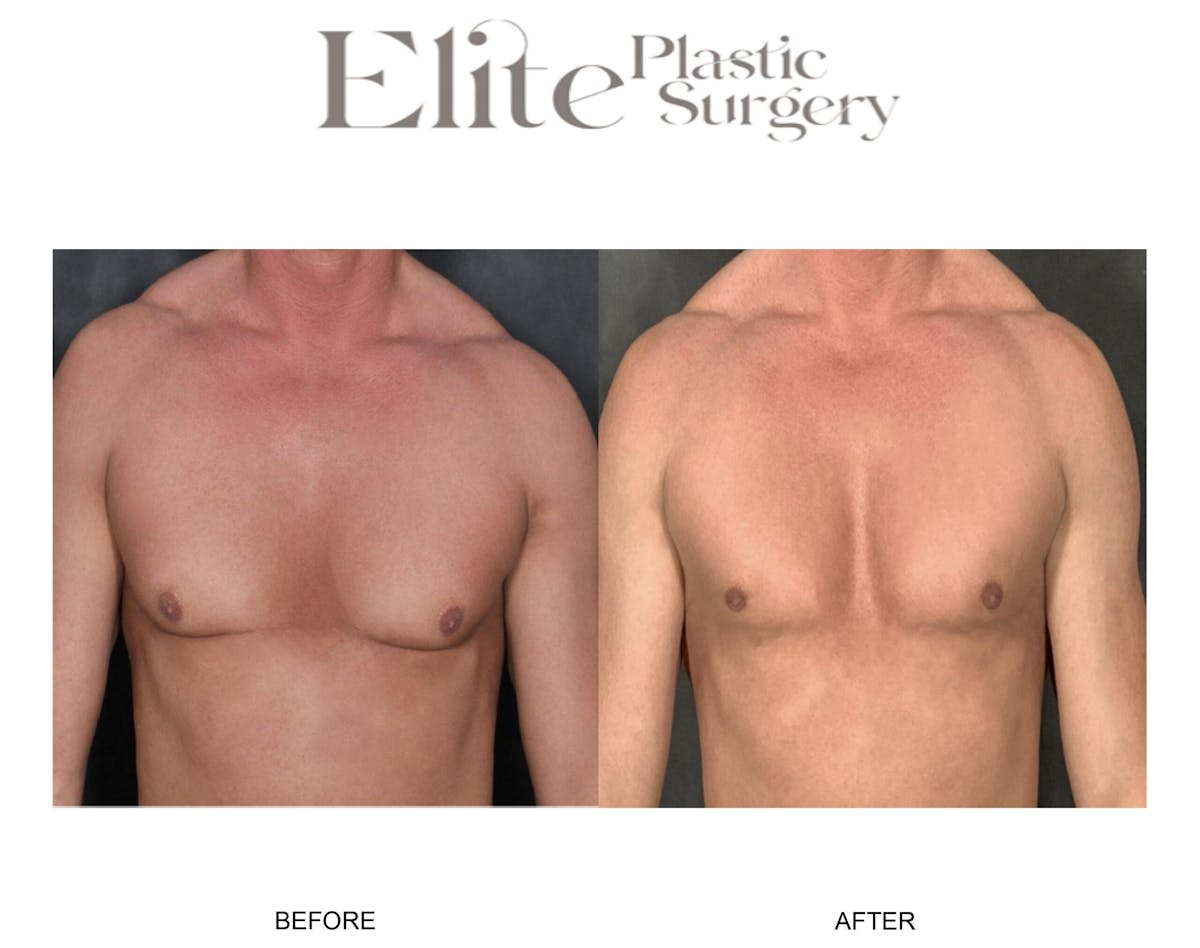 Male Gynecomastia Before & After Gallery - Patient 382441 - Image 1