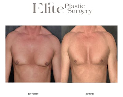 Male Gynecomastia Before & After Gallery - Patient 382441 - Image 1