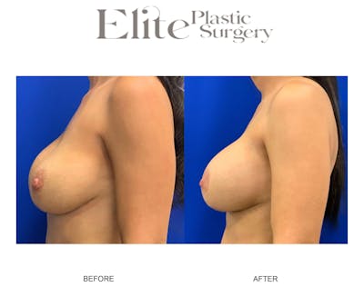 Mastopexy (Breast Lift) Before & After Gallery - Patient 114983 - Image 1