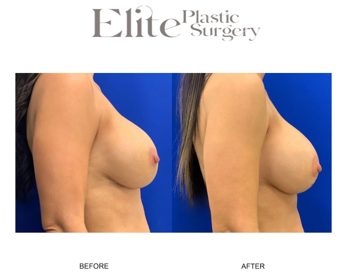 Mastopexy (Breast Lift) Before & After Gallery - Patient 114983 - Image 2