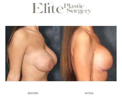 Mastopexy (Breast Lift) Before & After Gallery - Patient 115432 - Image 1