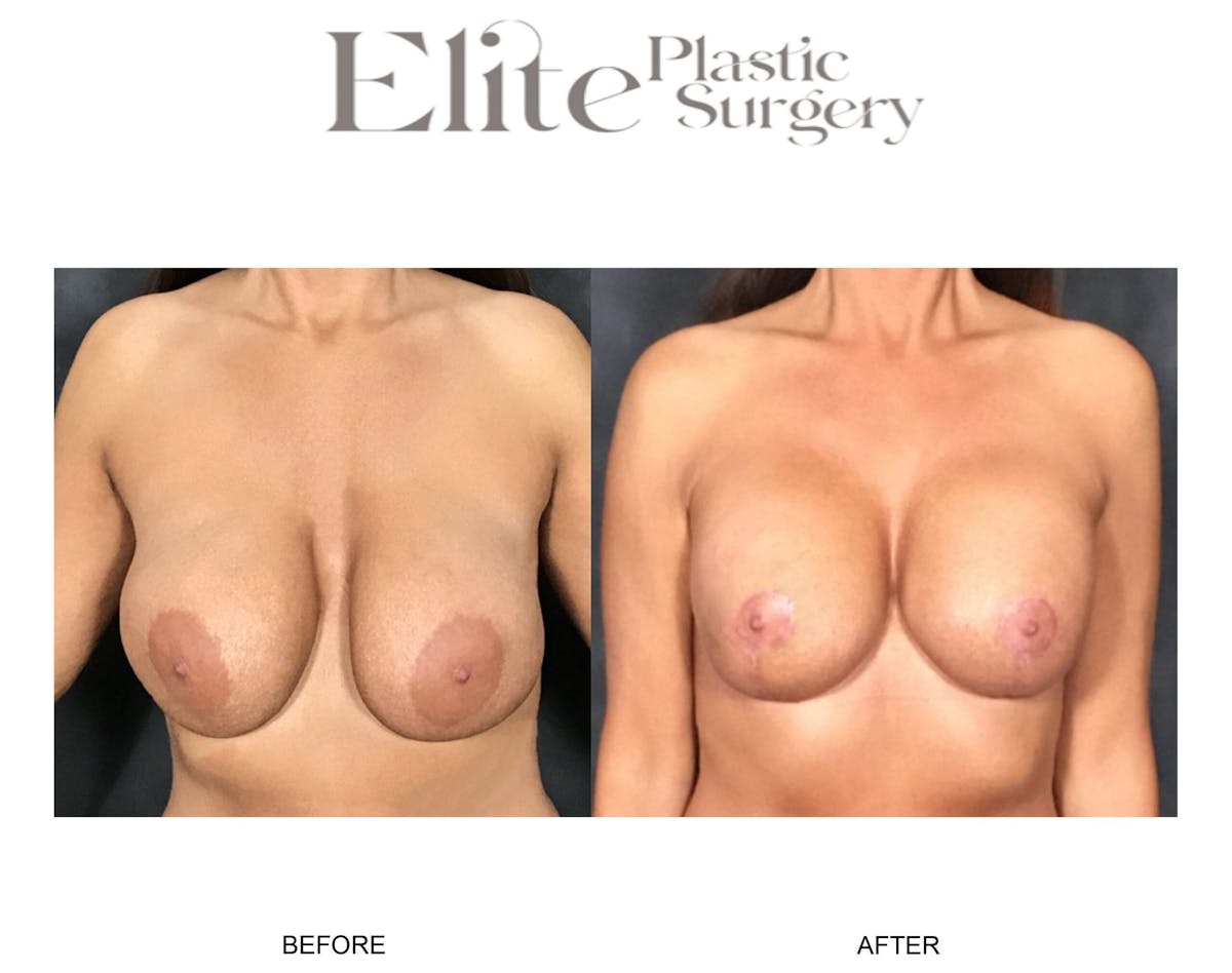 Breast Lift (Mastopexy) Before & After Gallery - Patient 115432 - Image 2