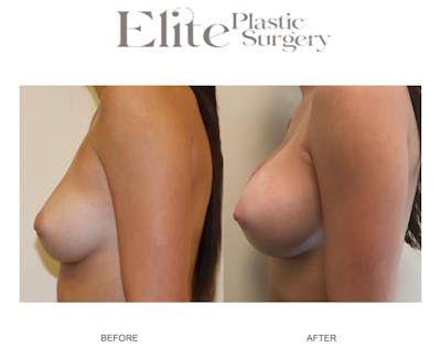 Breast Augmentation Before & After Gallery - Patient 372266 - Image 1