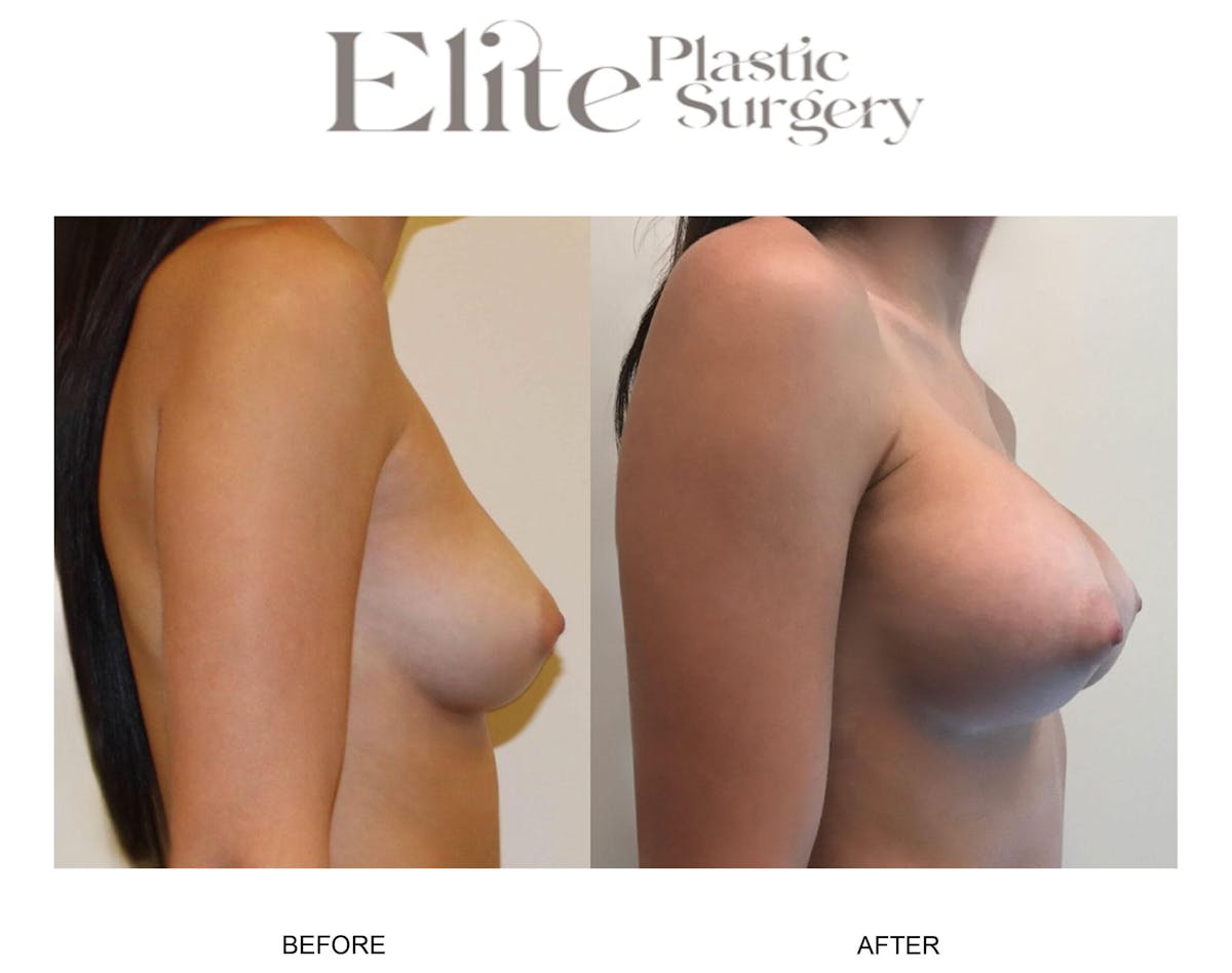 Breast Augmentation Before & After Gallery - Patient 372266 - Image 2