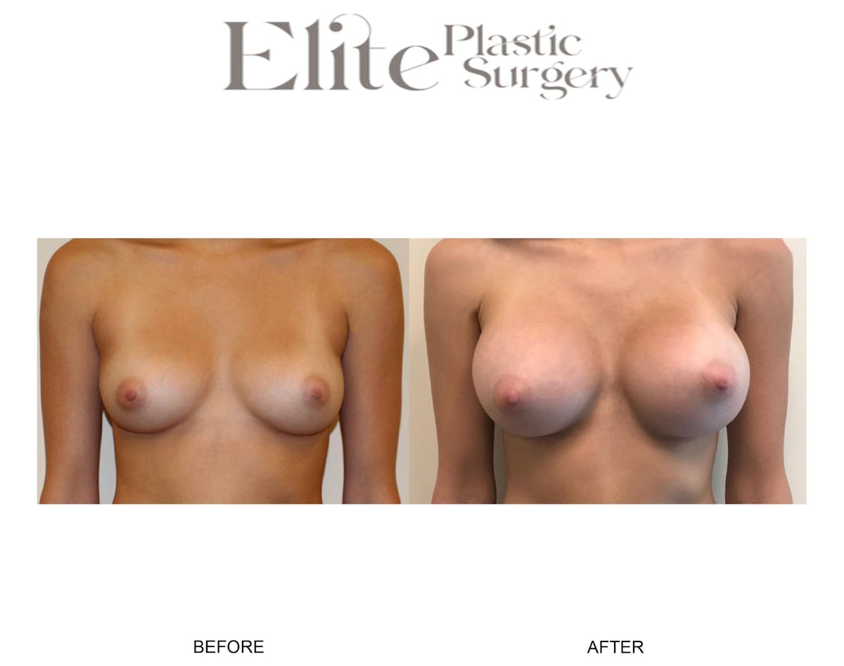 Breast Augmentation Before & After Gallery - Patient 372266 - Image 3