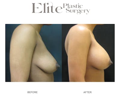 Breast Augmentation Before & After Gallery - Patient 247079 - Image 1