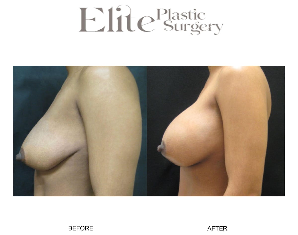 Breast Augmentation Before & After Gallery - Patient 247079 - Image 2
