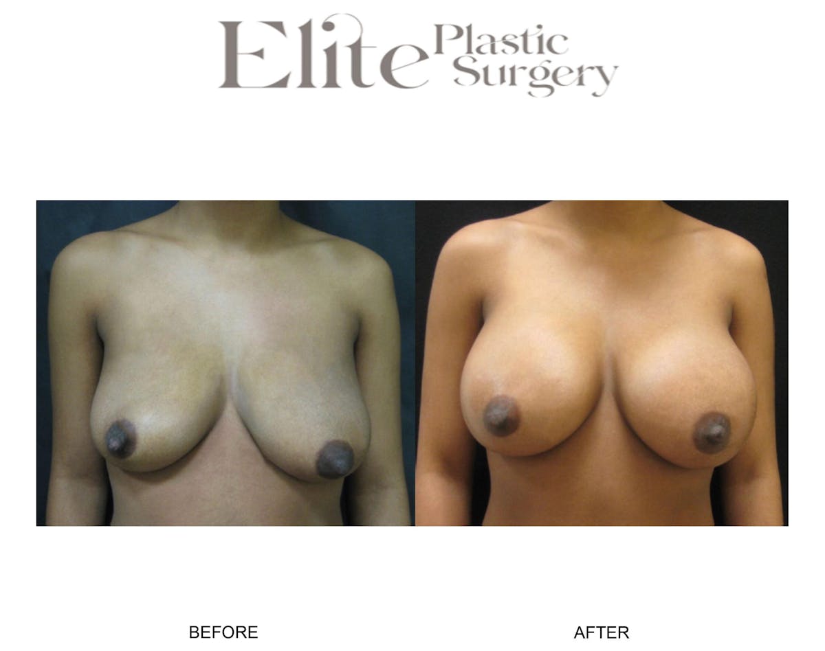 Breast Augmentation Before & After Gallery - Patient 247079 - Image 3