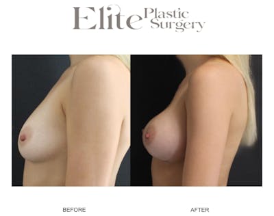 Breast Augmentation Before & After Gallery - Patient 778636 - Image 1