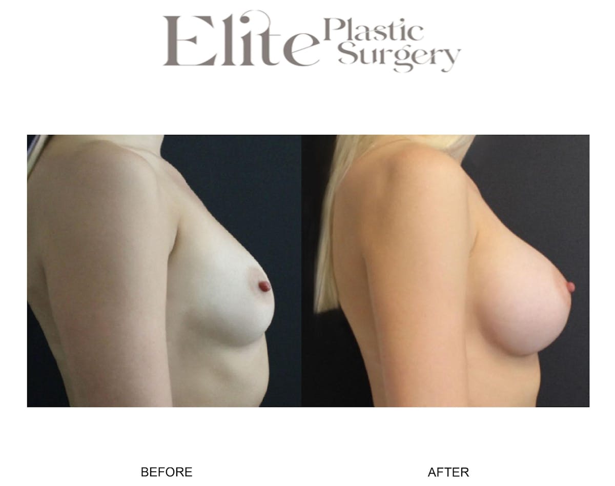 Breast Augmentation Before & After Gallery - Patient 778636 - Image 2