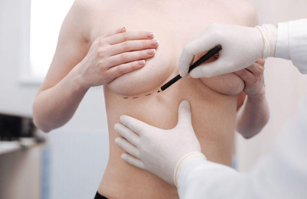 woman preparing for breast surgery