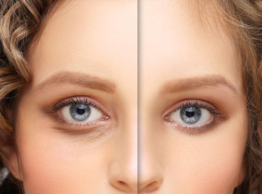 woman before and after blepharoplasty