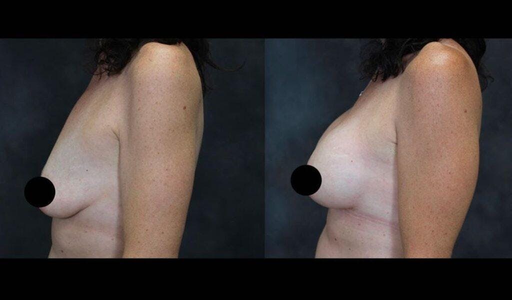 breast surgery results