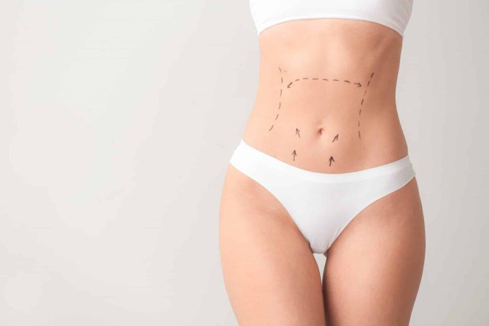 woman with drawings on her abdomen before cosmetic surgery