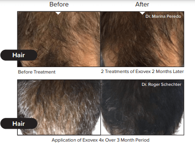 hair restoration results