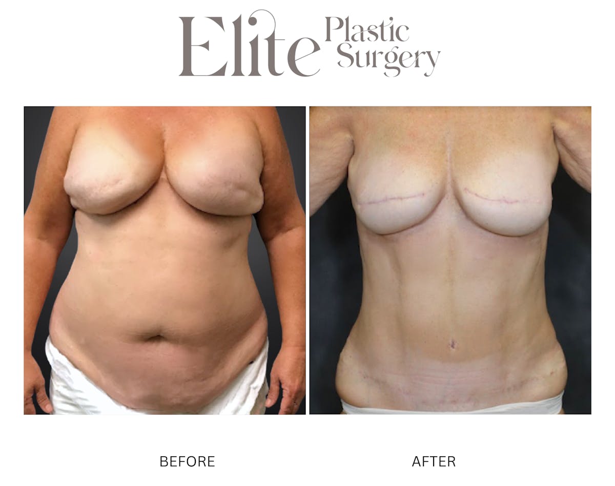 DIEP Breast Reconstruction Before & After Gallery - Patient 301516 - Image 1