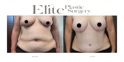DIEP Breast Reconstruction Before & After Gallery - Patient 409146 - Image 1