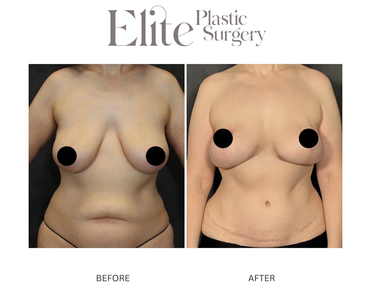 DIEP Breast Reconstruction Before & After Gallery - Patient 268627 - Image 1