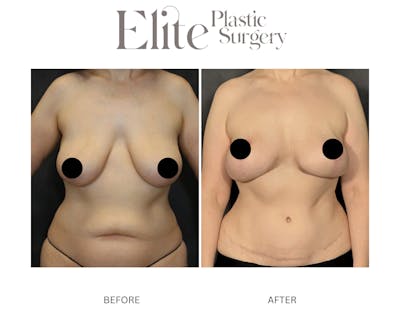 DIEP Breast Reconstruction Before & After Gallery - Patient 268627 - Image 1