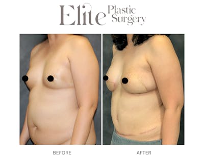 DIEP Breast Reconstruction Before & After Gallery - Patient 939751 - Image 1