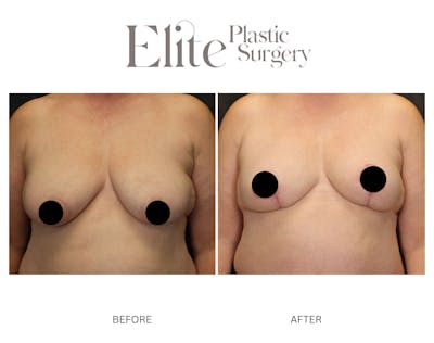 DIEP Breast Reconstruction Before & After Gallery - Patient 118382 - Image 1