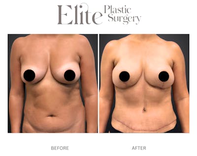 DIEP Breast Reconstruction Before & After Gallery - Patient 205365 - Image 1