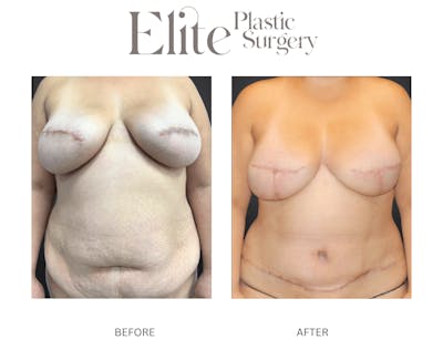 DIEP Breast Reconstruction Before & After Gallery - Patient 336048 - Image 1