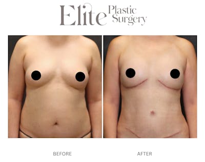 DIEP Breast Reconstruction Before & After Gallery - Patient 217759 - Image 1