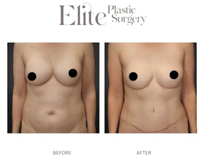 DIEP Breast Reconstruction Before & After Gallery - Patient 198833 - Image 1