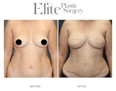 DIEP Breast Reconstruction Before & After Gallery - Patient 279107 - Image 1