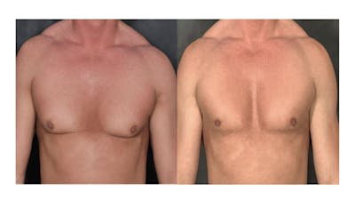Male Gynecomastia (LP) Before & After Gallery - Patient 416182 - Image 1