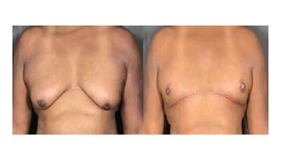 Male Gynecomastia (LP) Before & After Gallery - Patient 768346 - Image 1