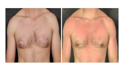 Male Gynecomastia (LP) Before & After Gallery - Patient 404249 - Image 1