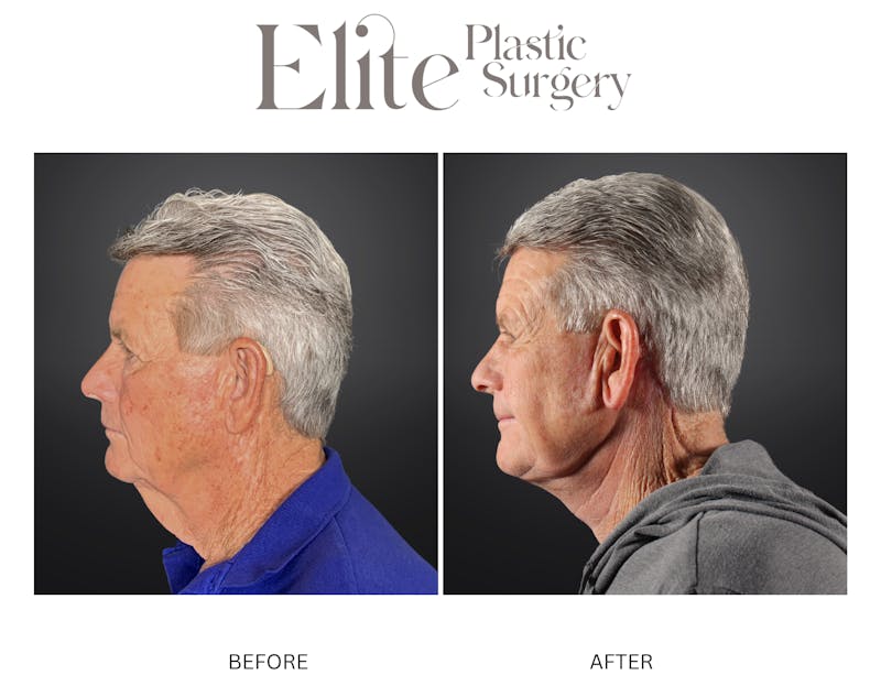 Neck Lift Before & After Gallery - Patient 290062 - Image 1