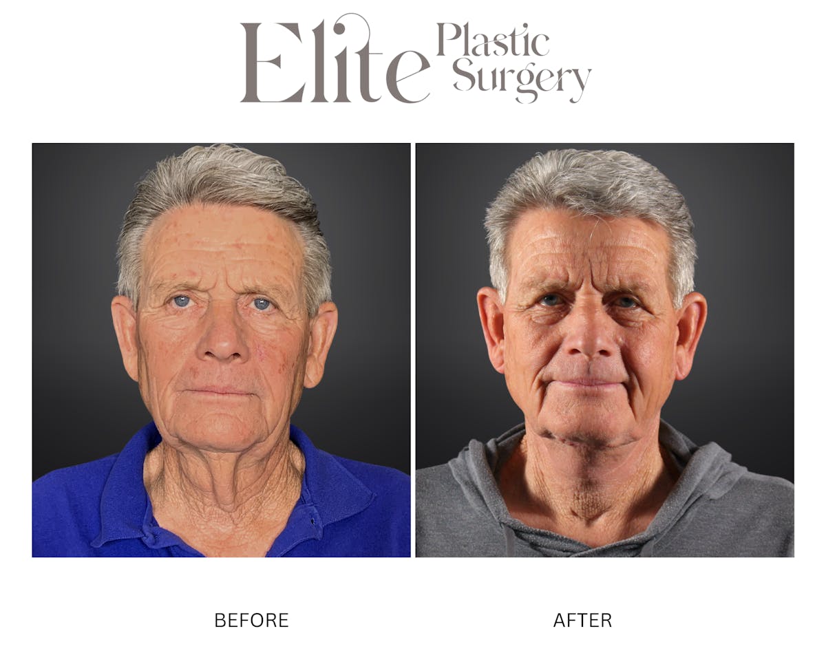 Neck Lift Before & After Gallery - Patient 290062 - Image 3
