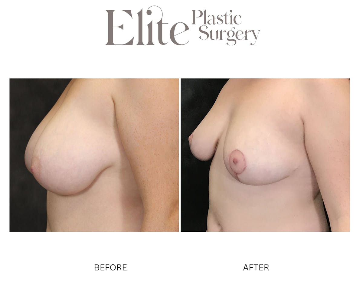 Breast Reduction Before & After Gallery - Patient 284091 - Image 2