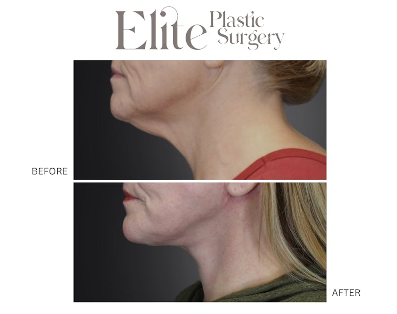 Neck Lift Before & After Gallery - Patient 413426 - Image 1