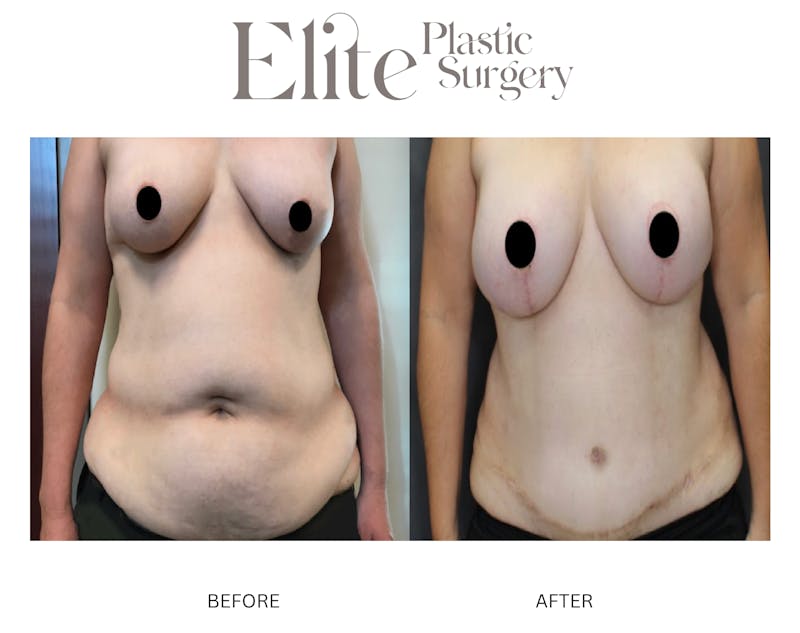 DIEP Breast Reconstruction Before & After Gallery - Patient 409146 - Image 1