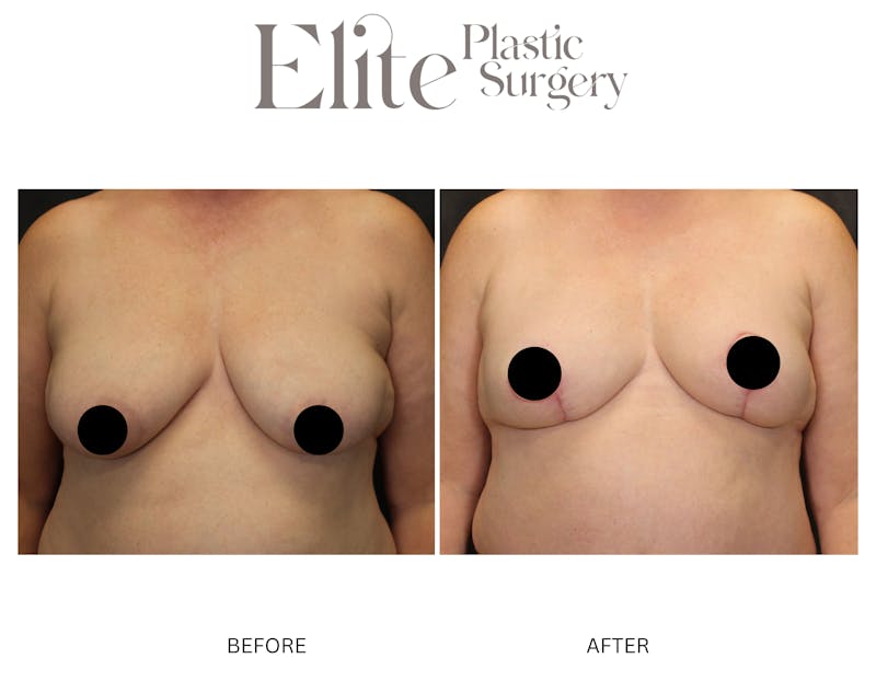DIEP Breast Reconstruction Before & After Gallery - Patient 118382 - Image 1