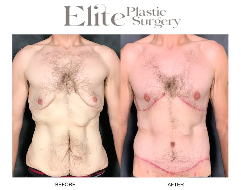 Body Lift (Surgery after Excessive Weightloss) Before & After Gallery - Patient 267114 - Image 1