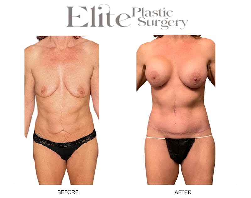 Body Lift (Surgery after Excessive Weightloss) Before & After Gallery - Patient 328821 - Image 1