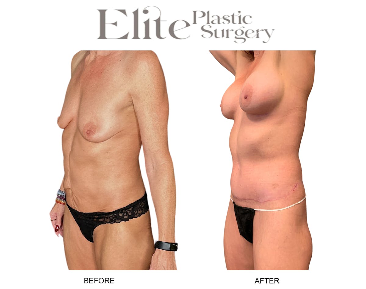 Body Lift (Surgery after Excessive Weightloss) Before & After Gallery - Patient 328821 - Image 2