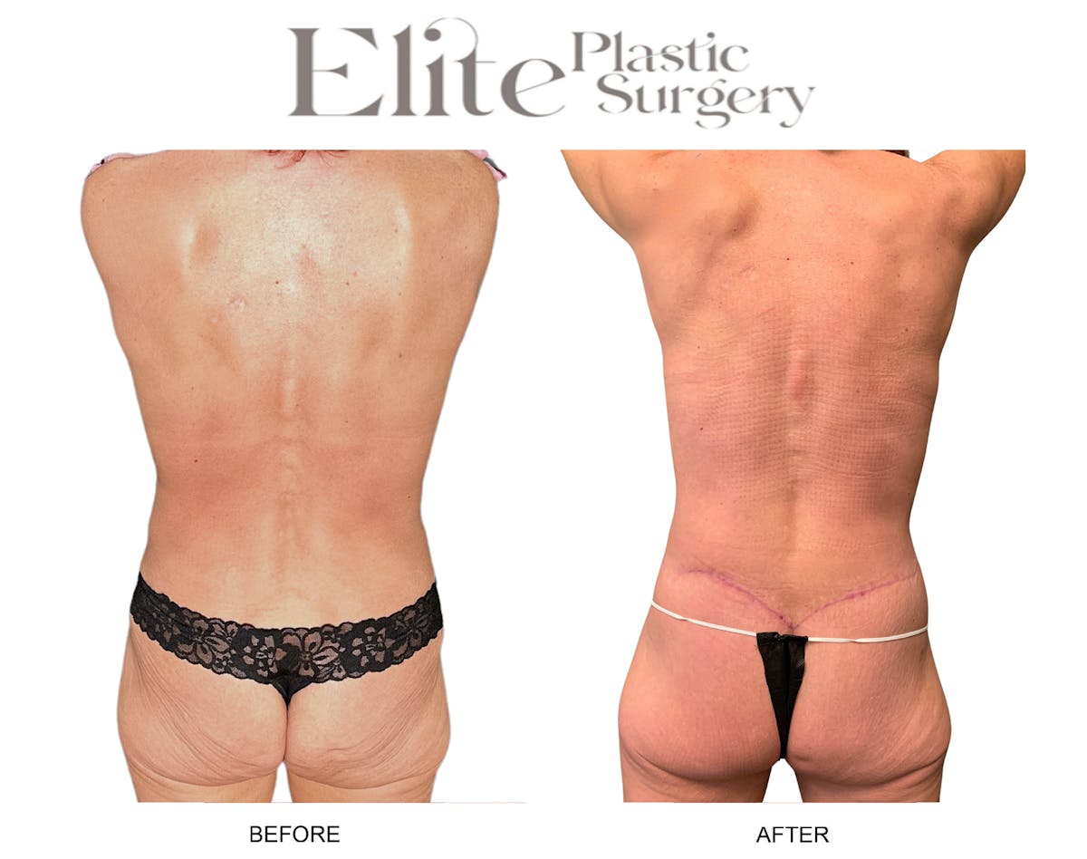 Body Lift (Surgery after Excessive Weightloss) Before & After Gallery - Patient 328821 - Image 3