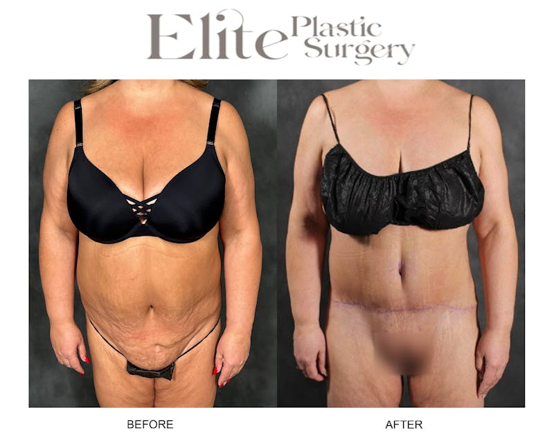 Abdominoplasty (Tummy Tuck) Before & After Gallery - Patient 103378 - Image 1