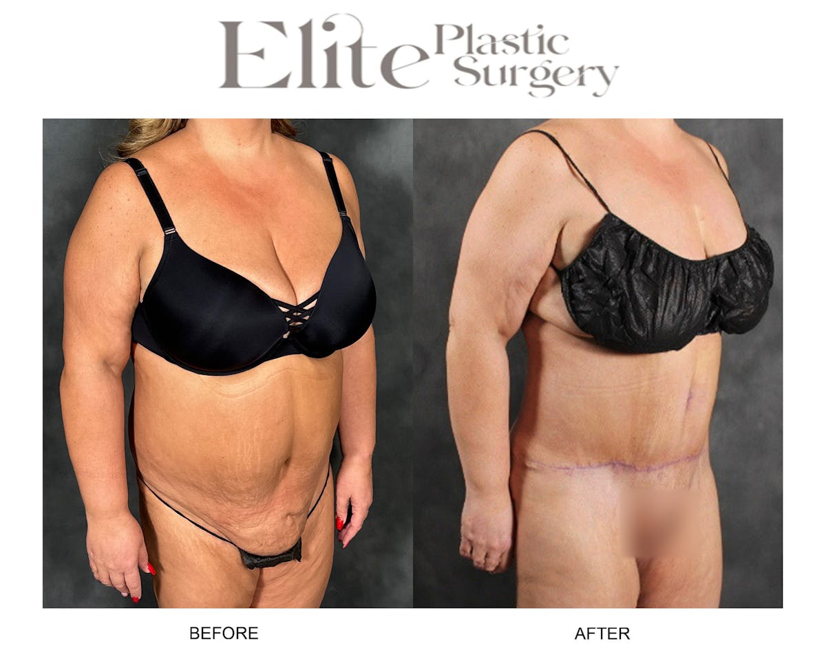 Abdominoplasty (Tummy Tuck) Before & After Gallery - Patient 103378 - Image 2