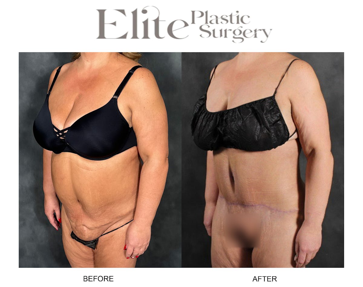 Abdominoplasty (Tummy Tuck) Before & After Gallery - Patient 103378 - Image 3